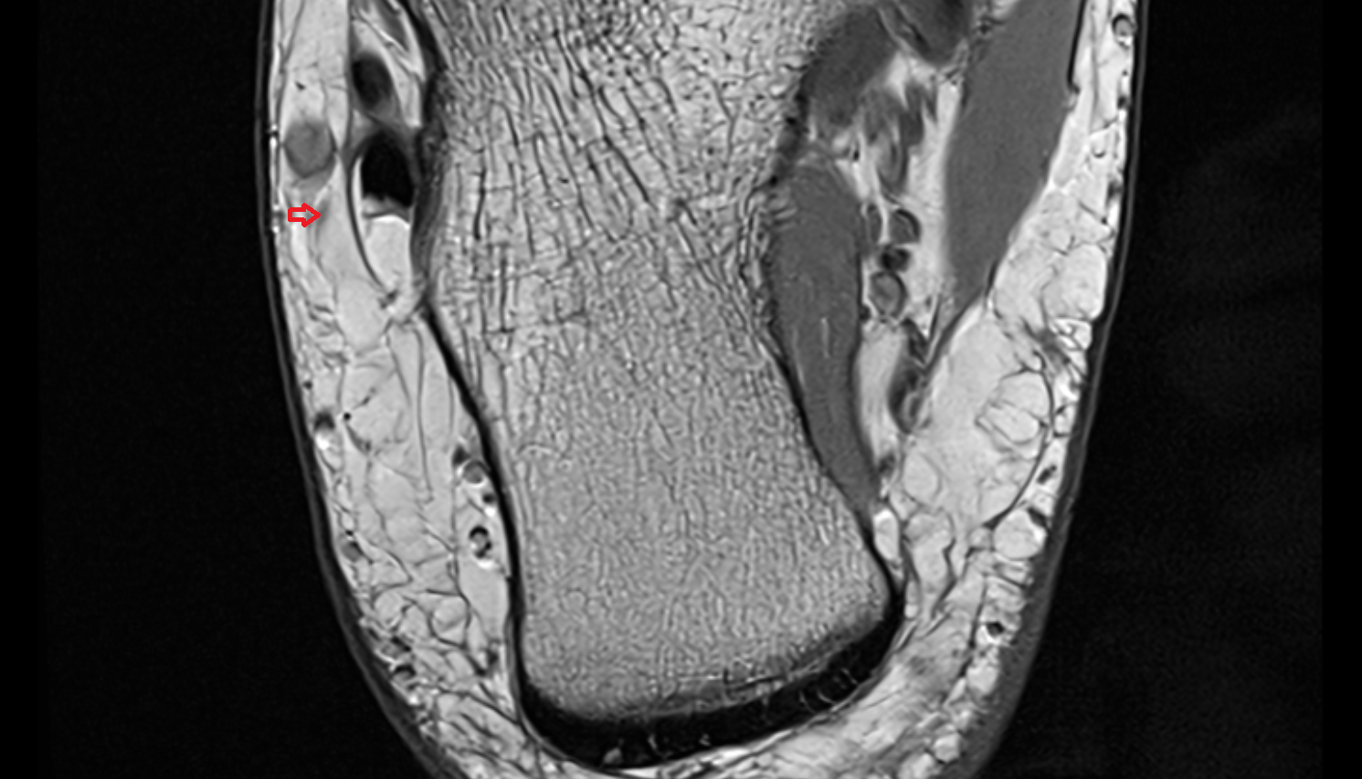 Lateral dorsal cutaneous nerve  axial cross sectional anatomy 3T MRI AI enhanced radiology image-img-00000-00000_00001