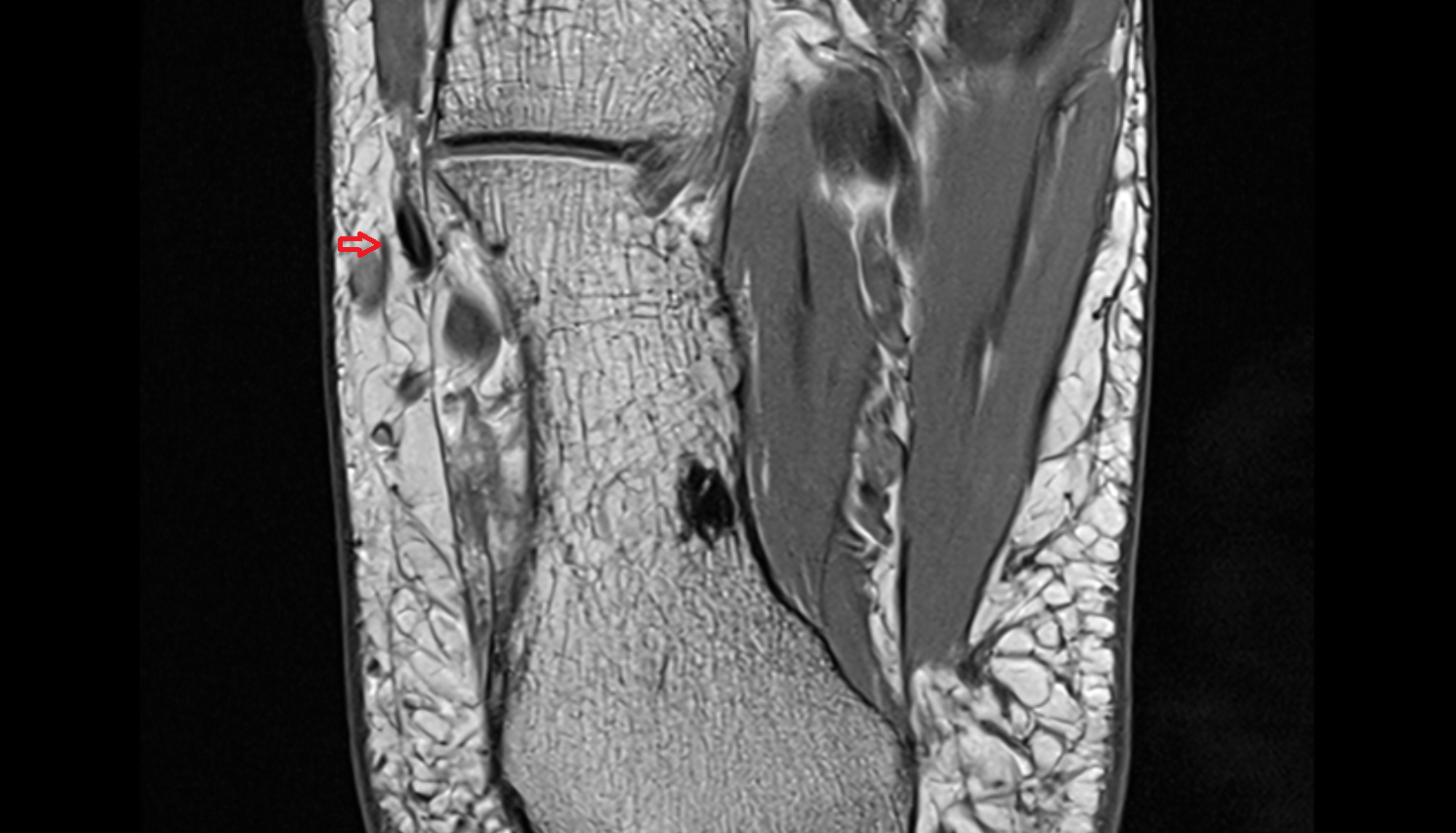 Lateral dorsal cutaneous nerve  axial cross sectional anatomy 3T MRI AI enhanced radiology image-img-00000-00000_00002