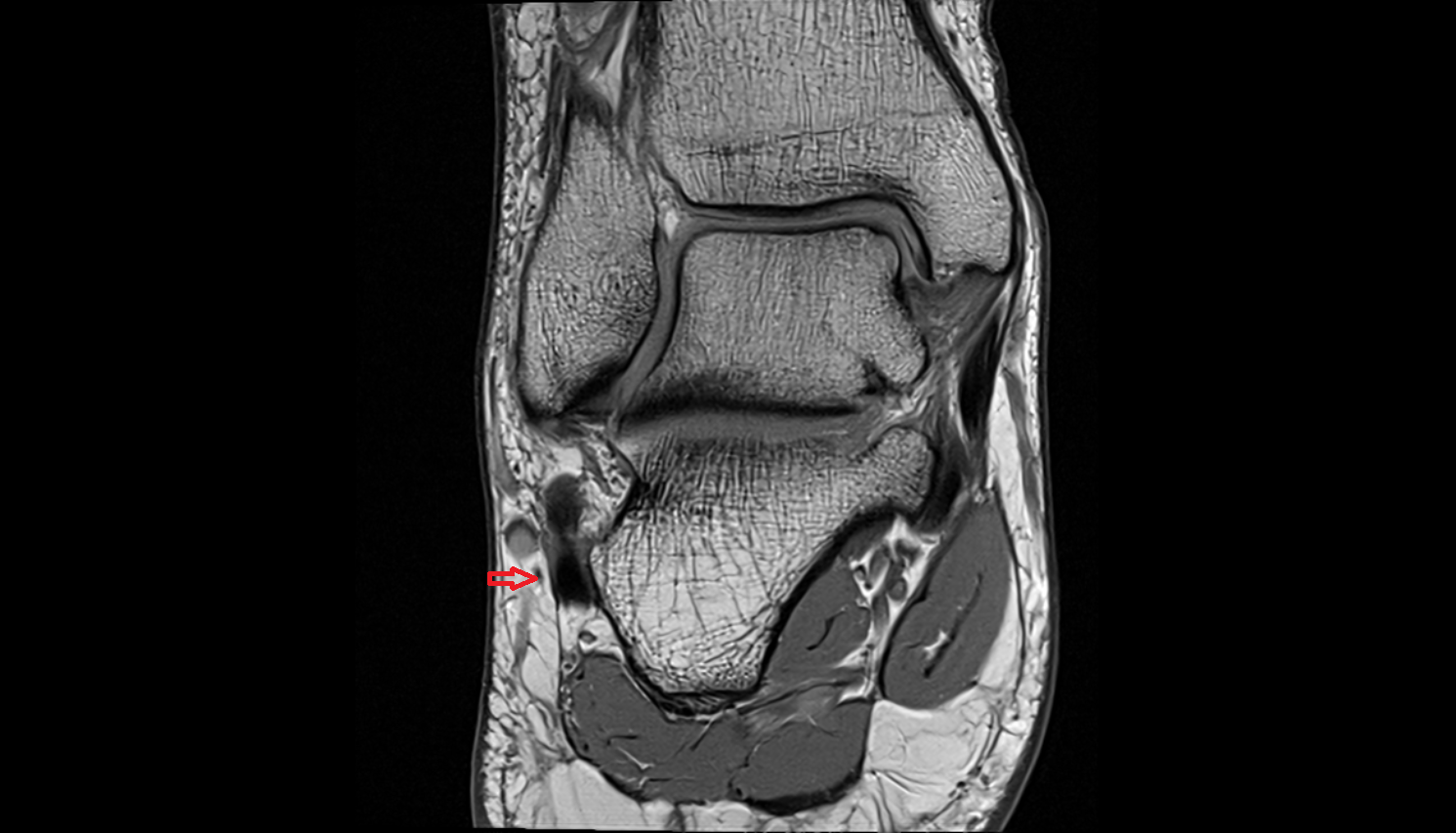Lateral dorsal cutaneous nerve coronal cross sectional anatomy 3T MRI AI enhanced radiology image-img-00000-00000