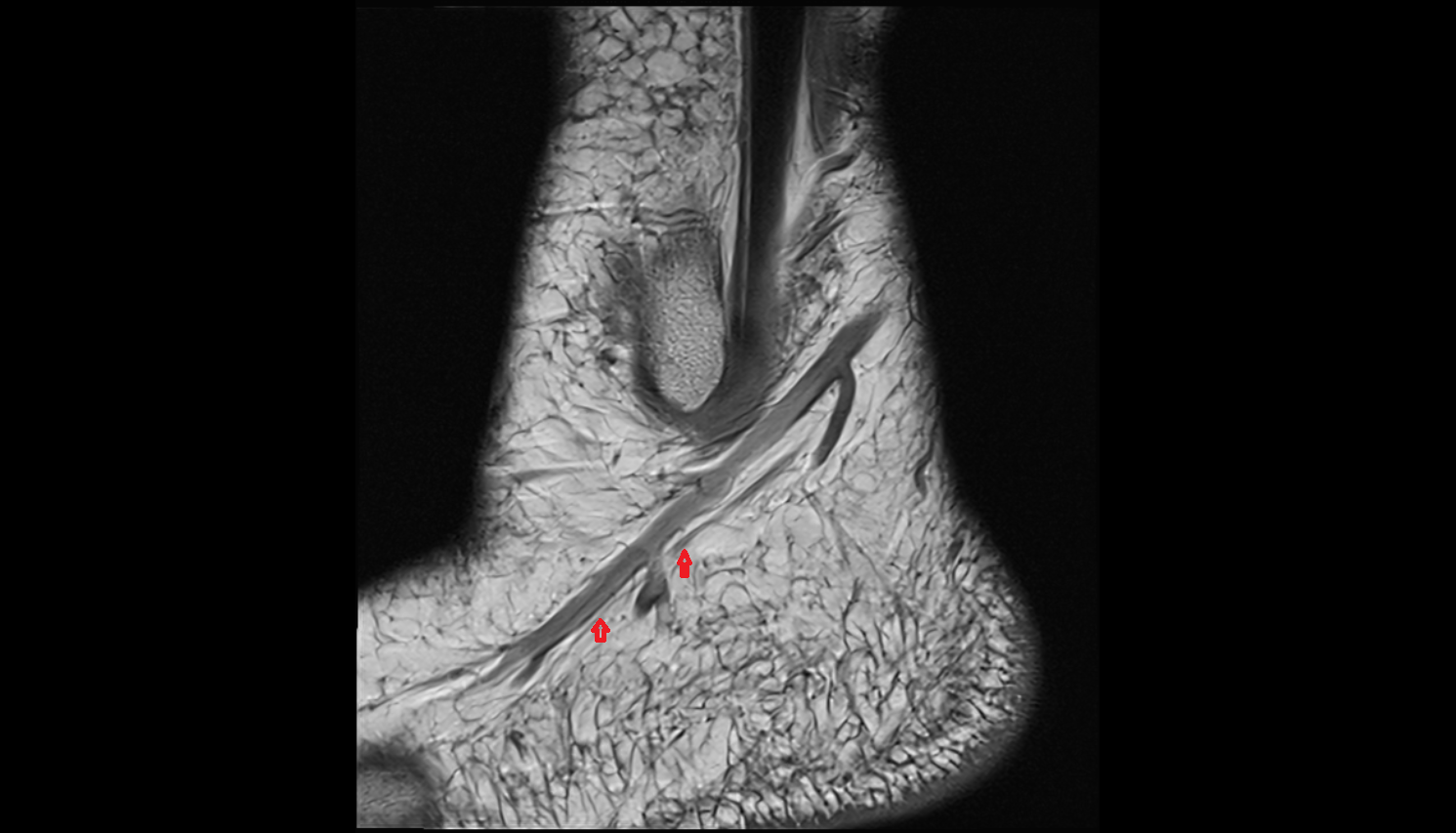 Lateral dorsal cutaneous nerve sagl cross sectional anatomy 3T MRI AI enhanced radiology image-img-00000-00000