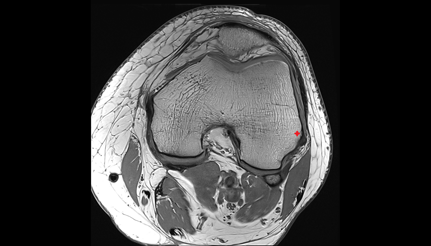 Lateral epicondyle of femur axial cross sectional anatomy 3T MRI AI enhanced  radiology  anatomy image-img-00000-00000