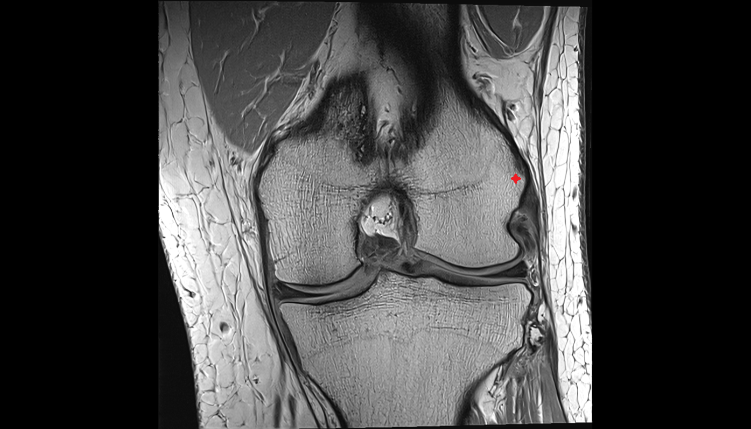 Lateral epicondyle of femur coronal cross sectional anatomy 3T MRI AI enhanced  radiology  anatomy image-img-00000-00000