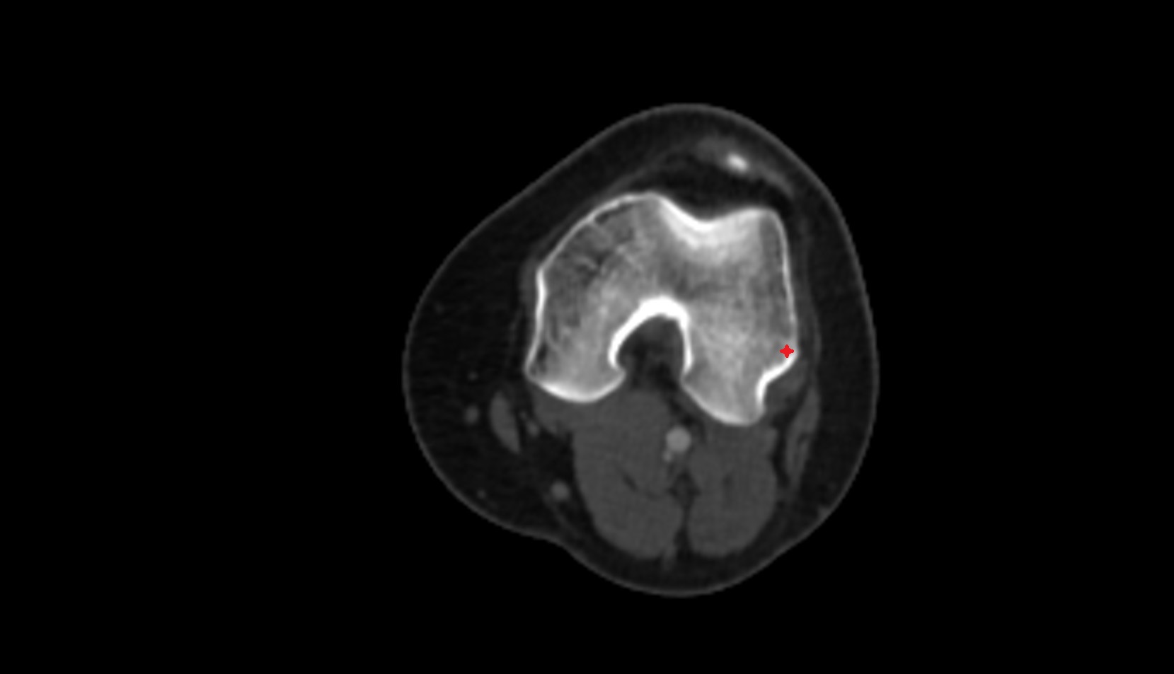 Lateral epicondyle of femur ct axial image