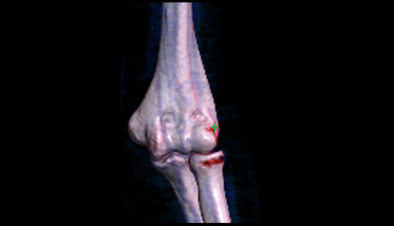 Lateral epicondyle of humerus 3D VRT image