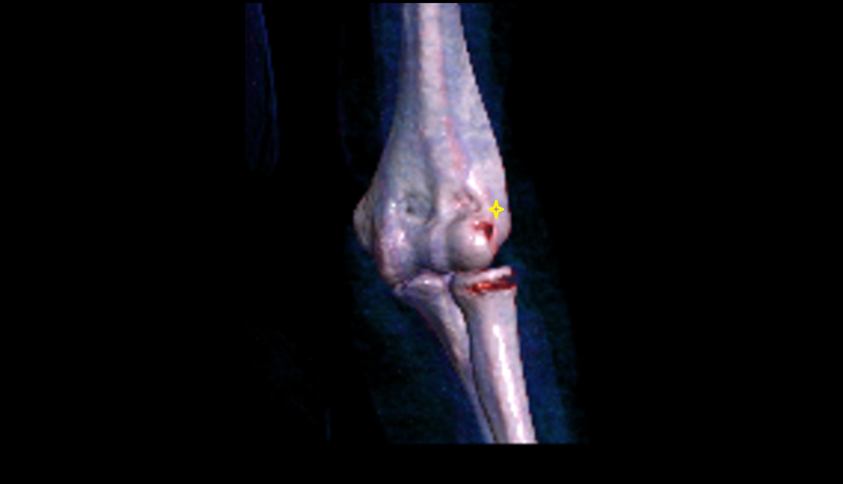 Lateral epicondyle of humerus 3d vrt