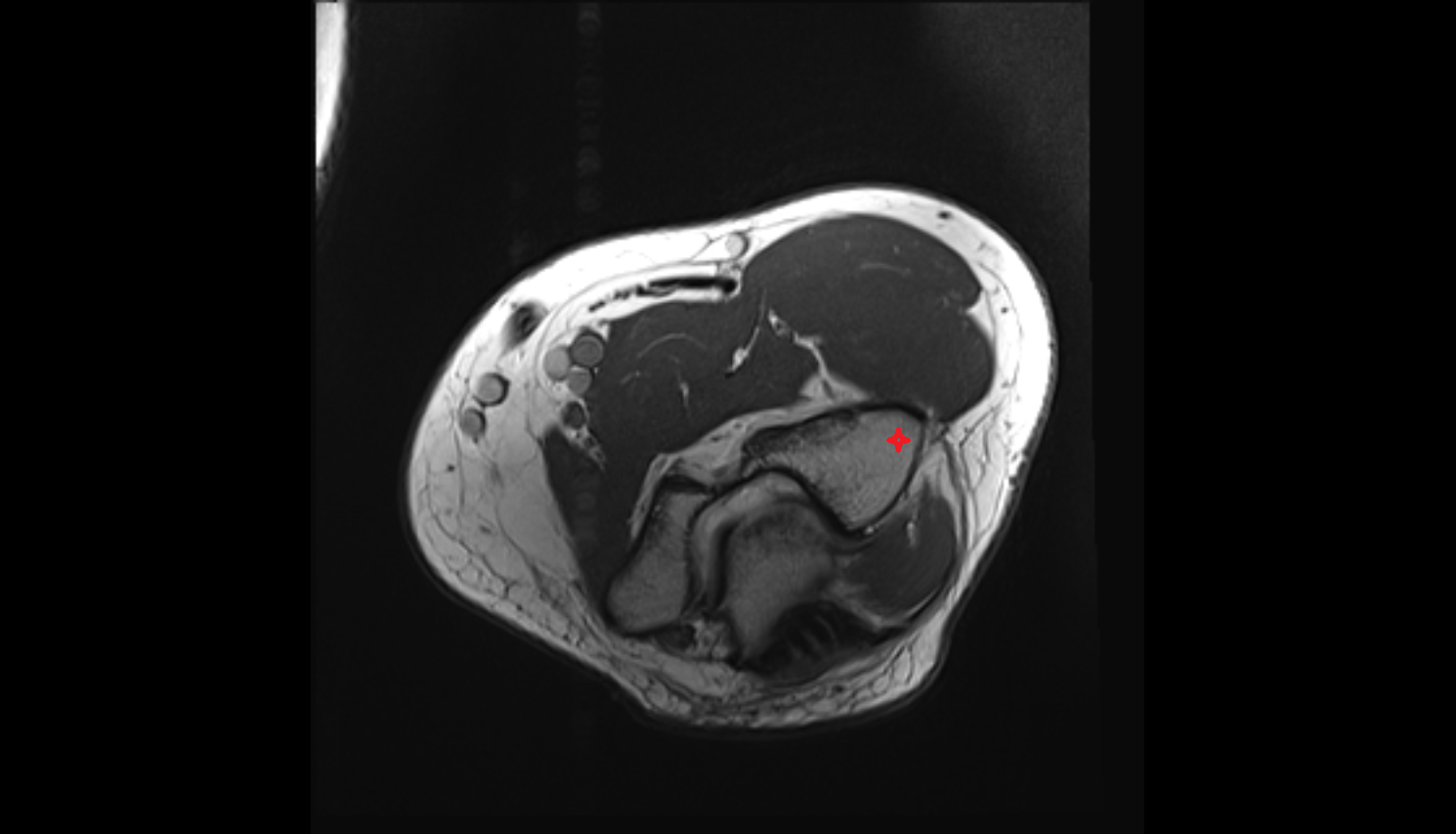Lateral epicondyle of humerus  axial cross sectional anatomy 3T MRI AI enhanced radiology image -img-00000-00000