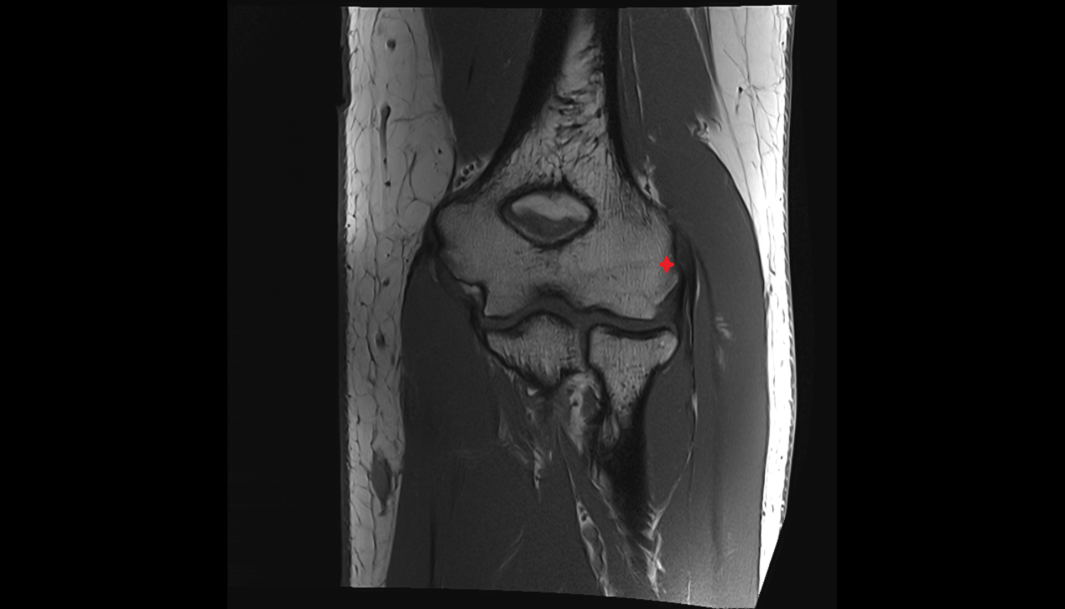 Lateral epicondyle of humerus  coronal cross sectional anatomy 3T MRI AI enhanced radiology image -img-00000-00000