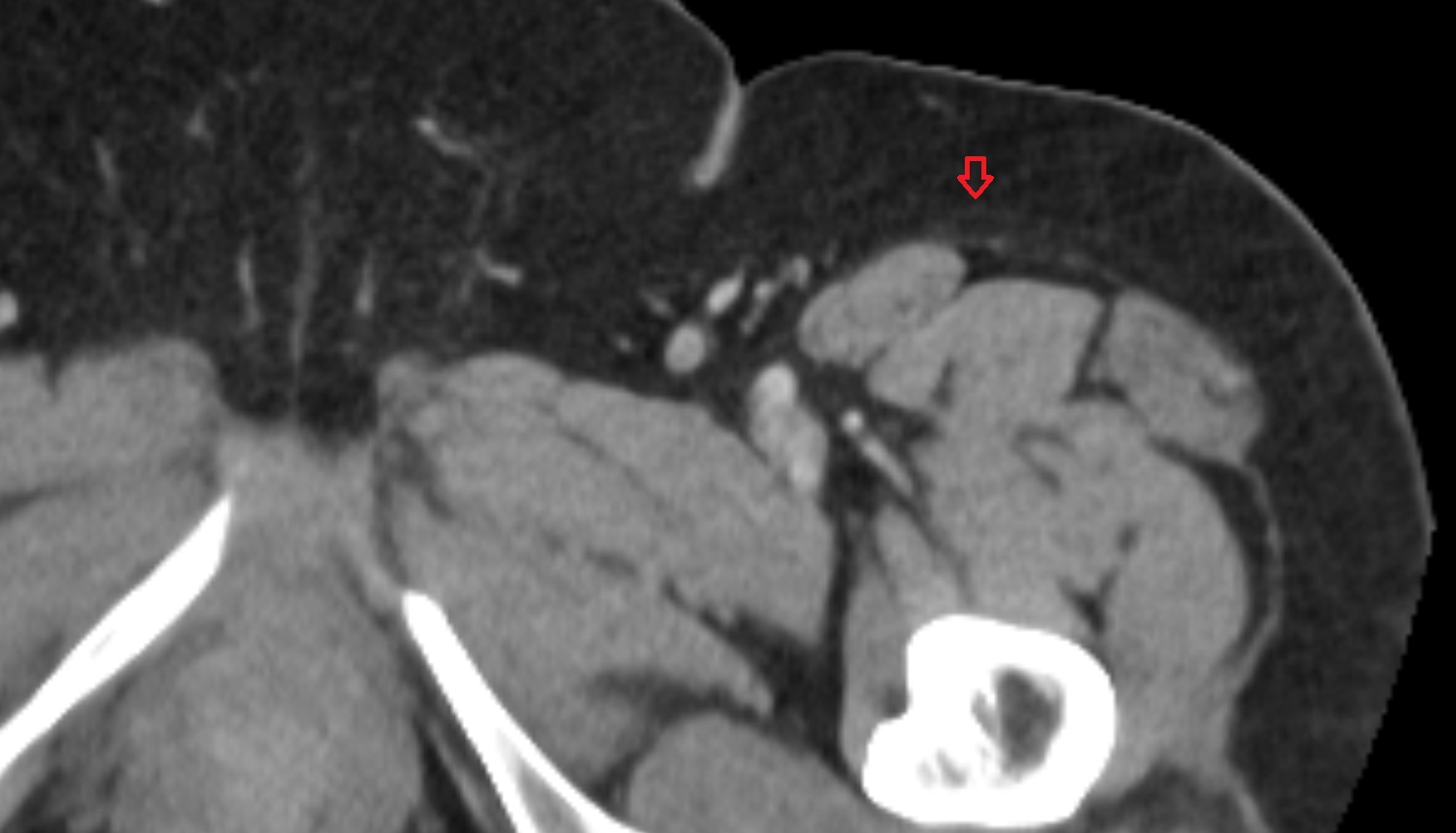Lateral femoral cutaneous nerve  MRI  axial  anatomy  image-img-00000-00000_00003