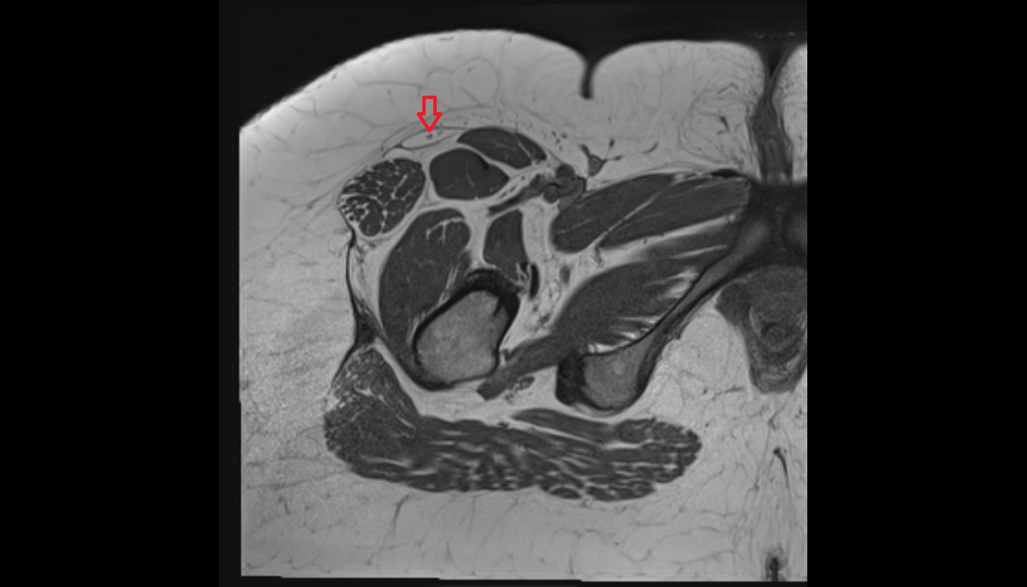 Lateral femoral cutaneous nerve  MRI  axial  anatomy  image