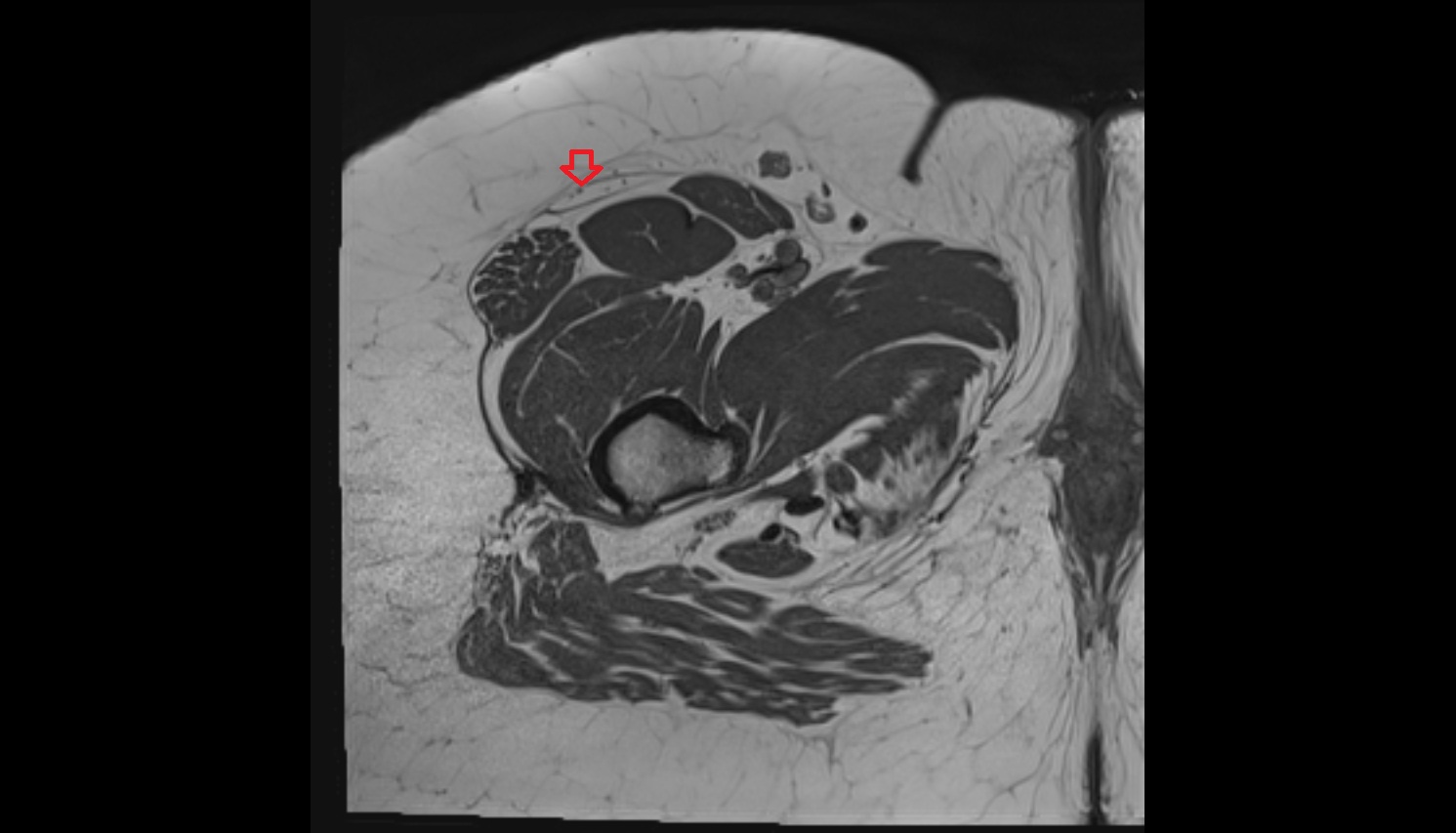 Lateral femoral cutaneous nerve  MRI  axial  anatomy  image