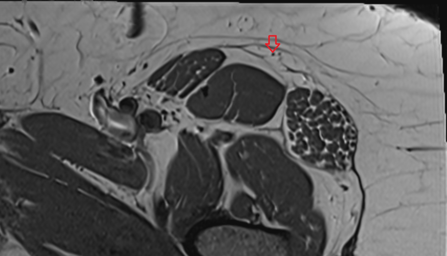 Lateral femoral cutaneous nerve  MRI  axial  anatomy  image-img-00000-00000_00002