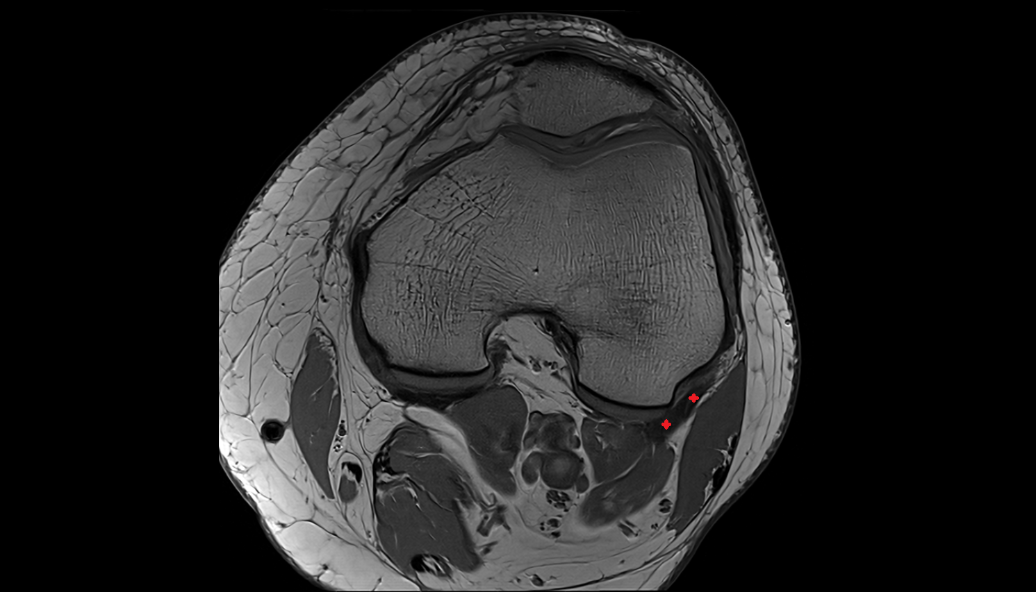 Lateral gastrocnemius tendon axial  cross sectional anatomy 3T MRI AI enhanced  radiology  anatomy image-img-00000-00000