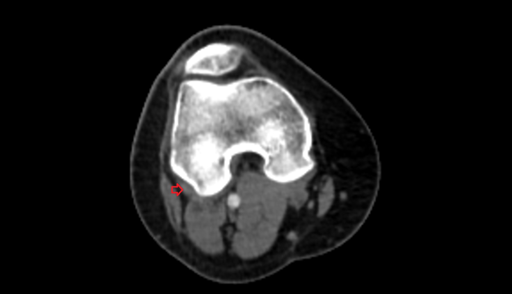 Lateral gastrocnemius tendon axial ct image