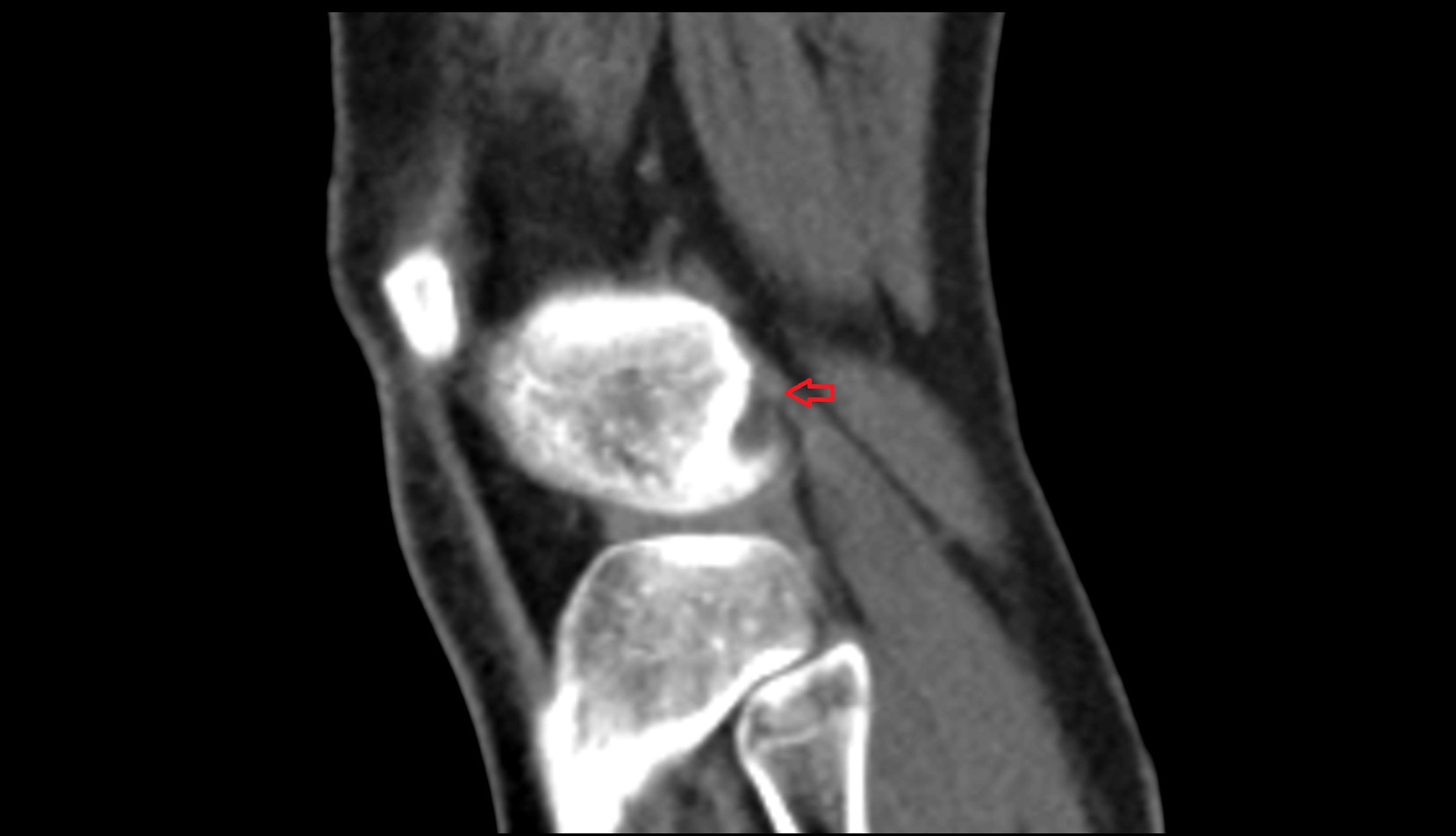 Lateral gastrocnemius tendon ct sagittal image
