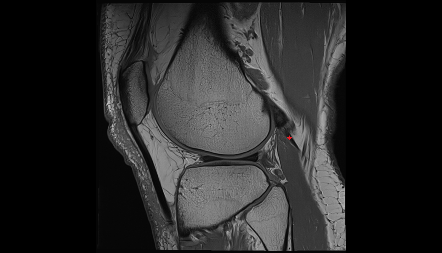 Lateral gastrocnemius tendon  sag  cross sectional anatomy 3T MRI AI enhanced  radiology  anatomy image-img-00000-00000