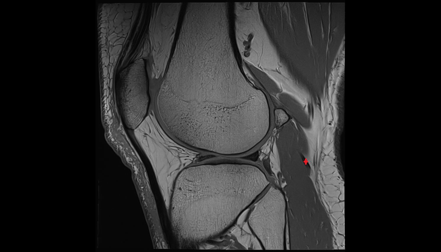 Lateral gastrocnemius tendon  sag  cross sectional anatomy 3T MRI AI enhanced  radiology  anatomy image-img-00000-00000_00001
