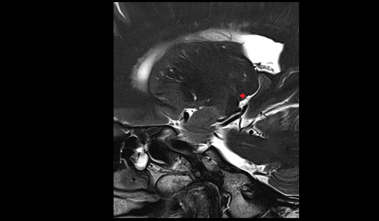 Lateral geniculate body mri 3t sagittal image