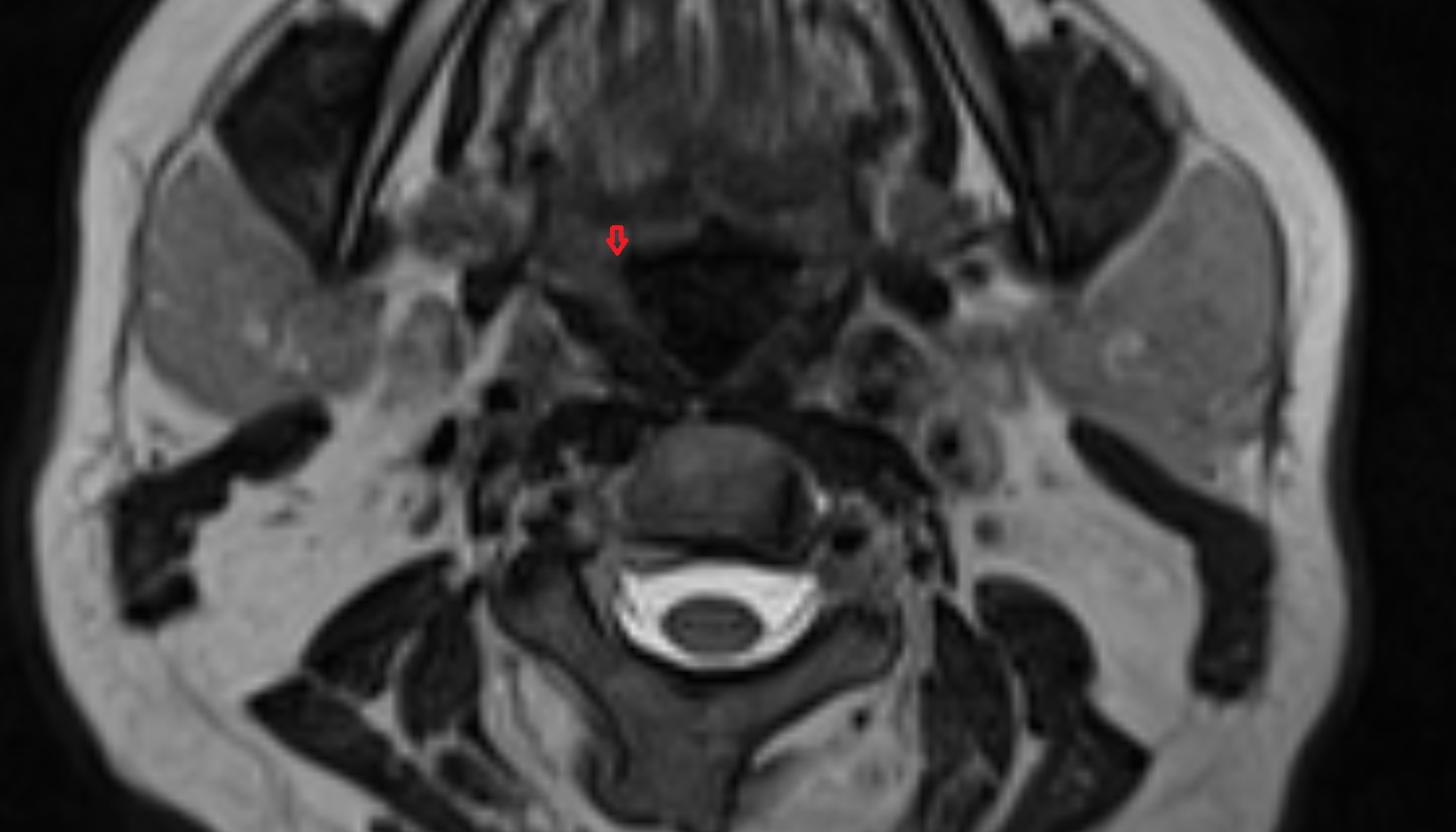 Lateral glossoepiglottic fold mri image 1-img-00000-00000
