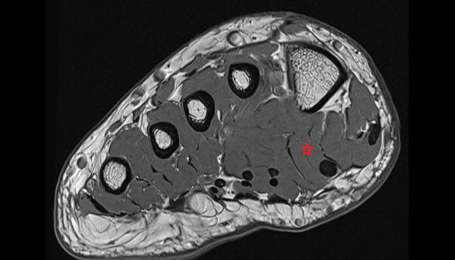 Lateral head of flexor hallucis brevis muscle axial cross sectional anatomy 3T MRI AI enhanced radiology image-img-00000-00000