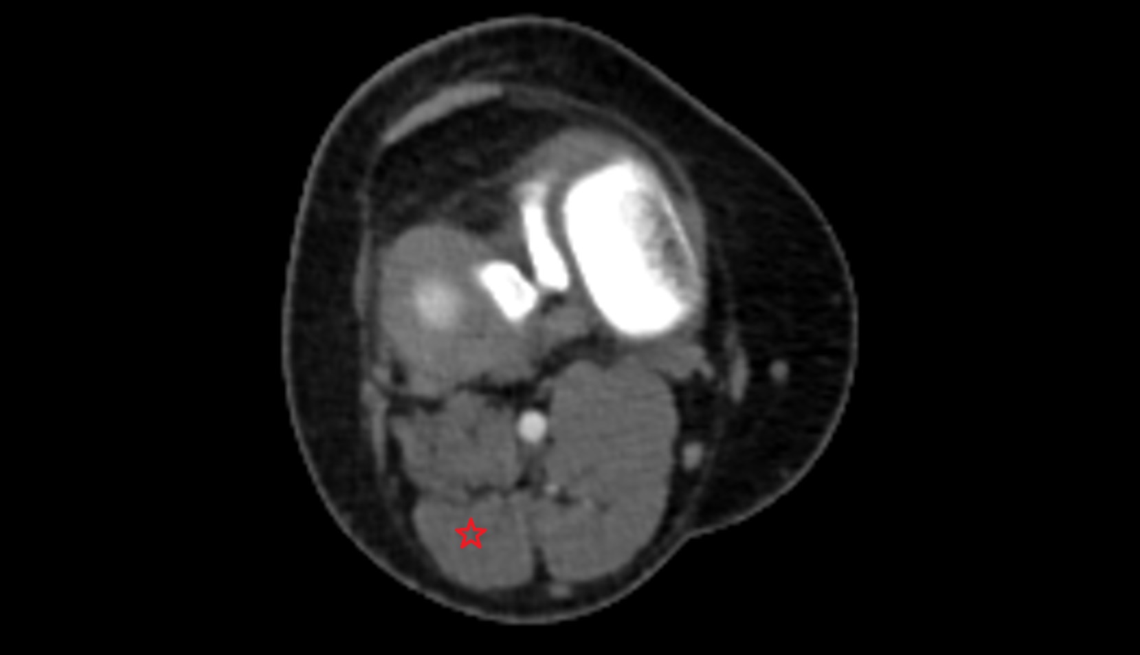 Lateral head of gastrocnemius muscle ct axial image