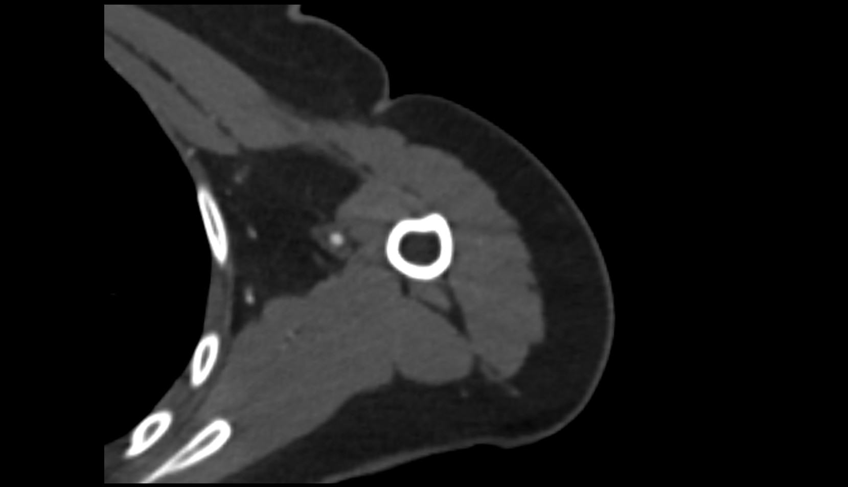 Lateral head of triceps brachii muscle CT axial