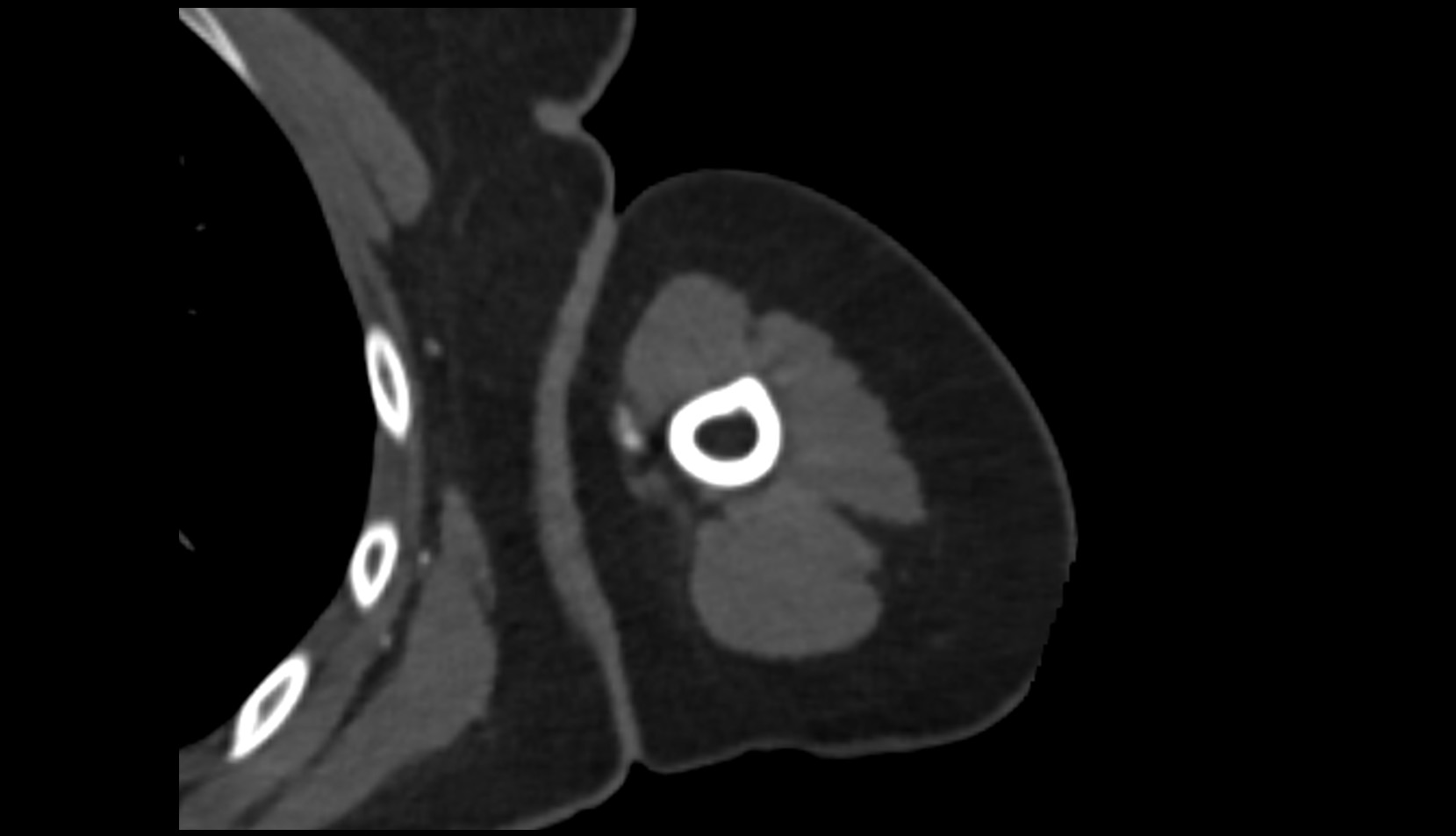 Lateral head of triceps brachii muscle CT axial 1