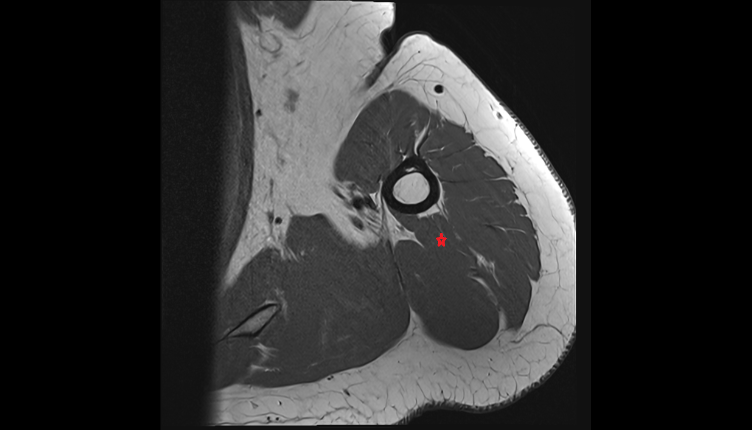 Lateral head of triceps brachii muscle  axial cross sectional anatomy 3T MRI AI enhanced radiology image-img-00000-00000