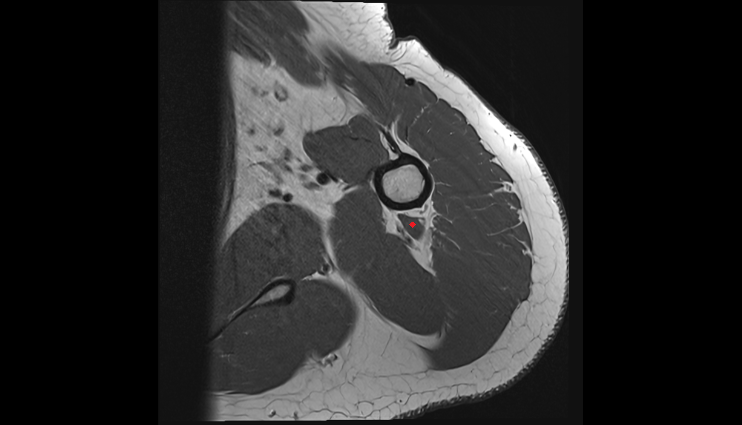 Lateral head of triceps brachii muscle  axial cross sectional anatomy 3T MRI AI enhanced radiology image-img-00000-00000_00001