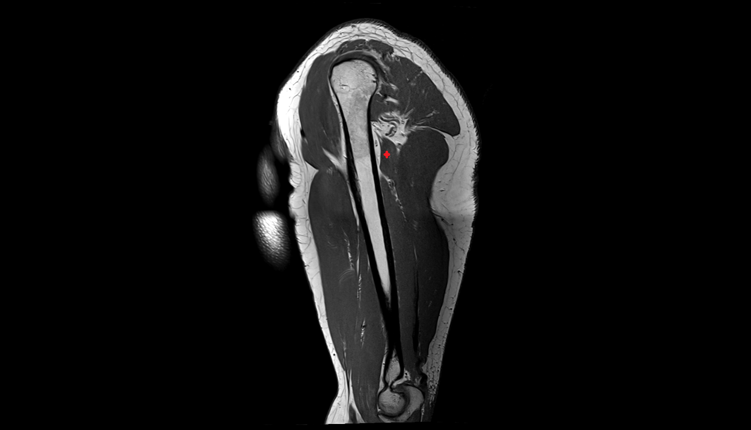 Lateral head of triceps brachii muscle  sag cross sectional anatomy 3T MRI AI enhanced radiology image-img-00000-00000