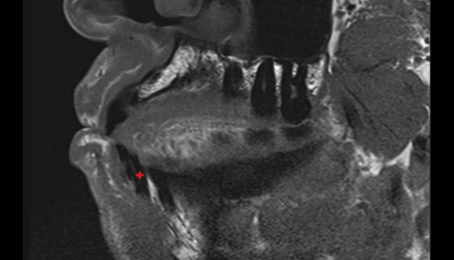 Lateral inferior incisor tooth mri sag  image -img-00000-00000
