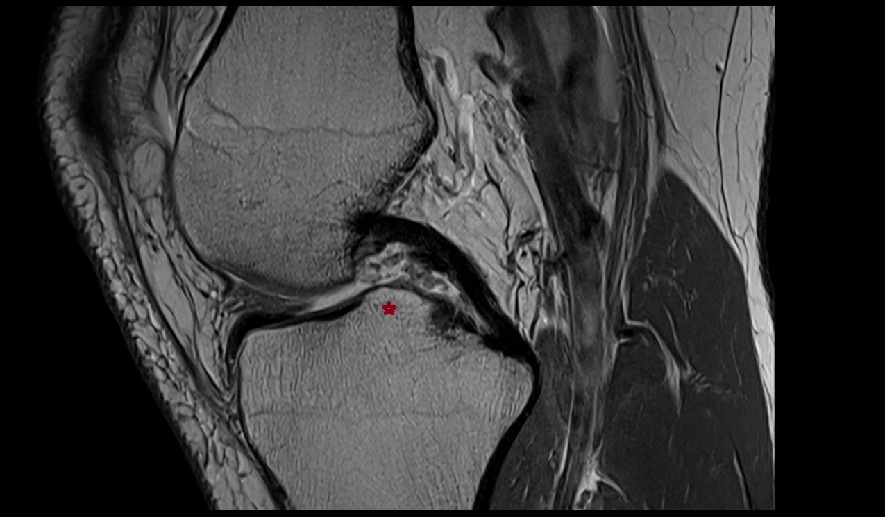 Lateral intercondylar tubercle