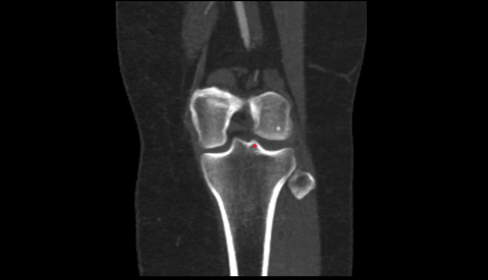 Lateral intercondylar tubercle of tibia ct coronal image