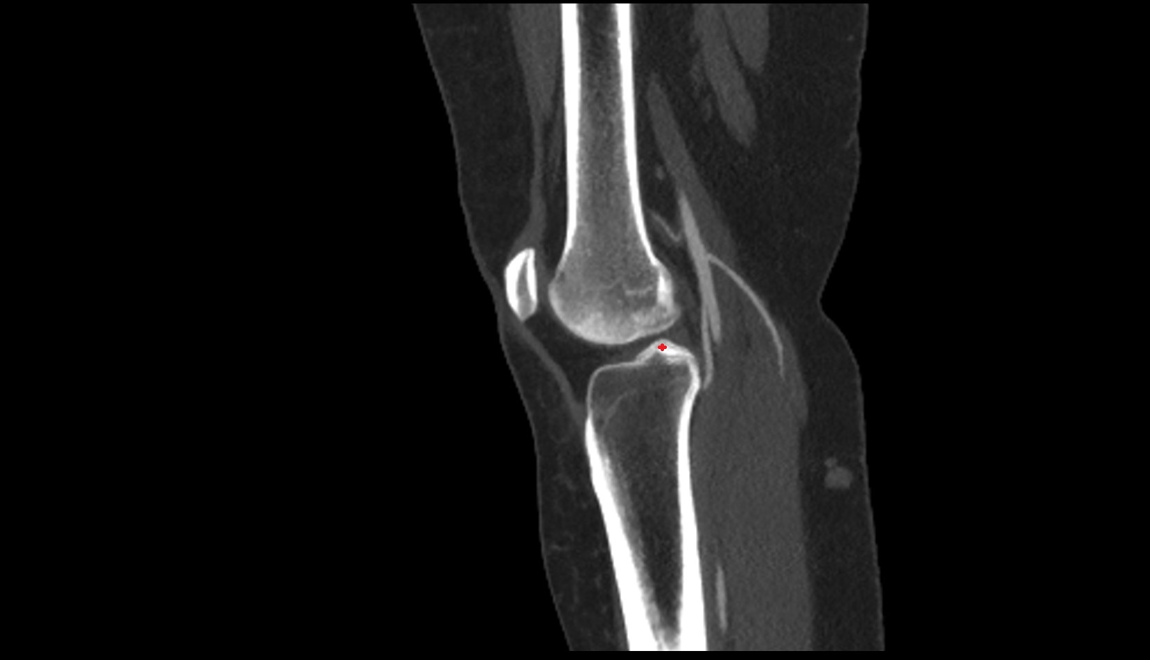 Lateral intercondylar tubercle of tibia ct sag