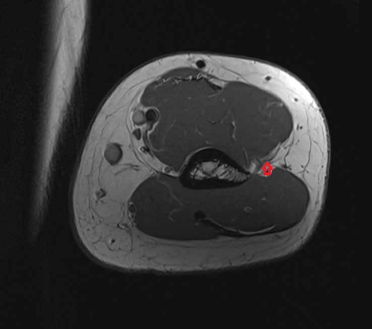 Lateral intermuscular septum axial cross sectional anatomy 3T MRI AI enhanced radiology image -img-00000-00000