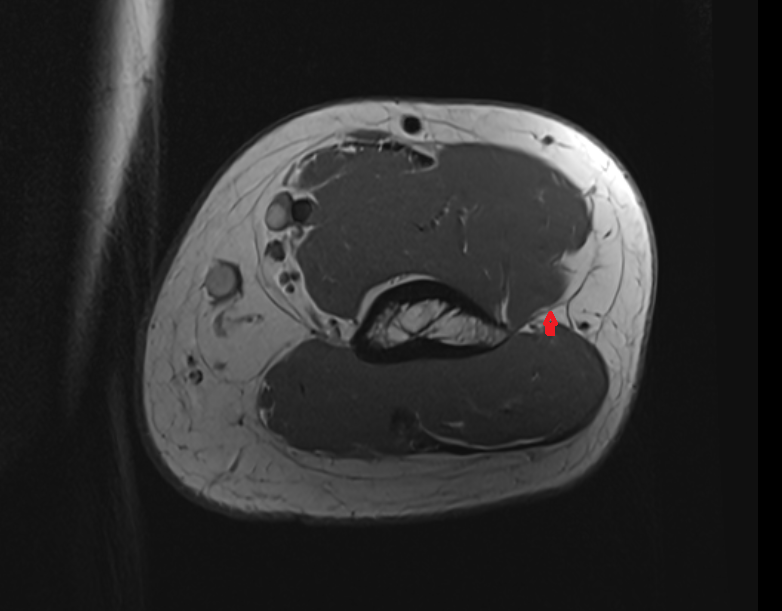 Lateral intermuscular septum axial cross sectional anatomy 3T MRI AI enhanced radiology image -img-00000-00000_00001