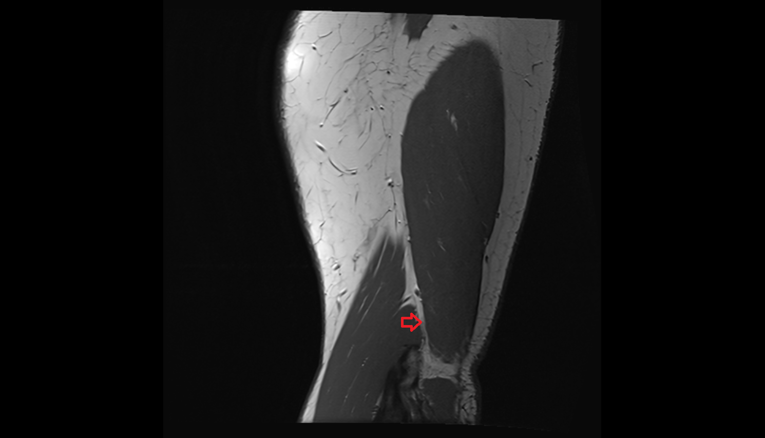 Lateral intermuscular septum sag cross sectional anatomy 3T MRI AI enhanced radiology image -img-00000-00000
