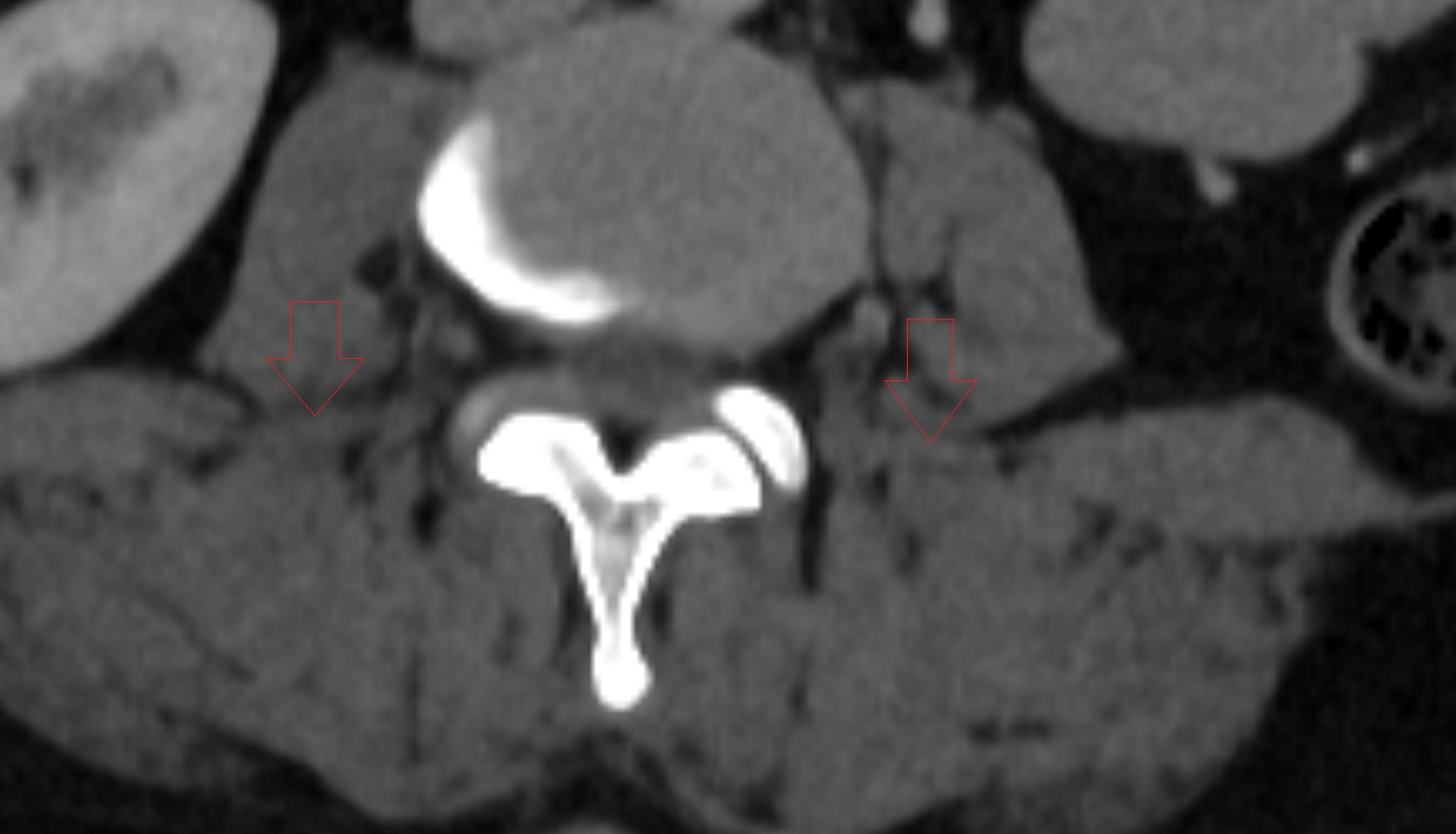 Lateral intertransversarii lumborum muscle CT axial  anatomy  image-img-00000-00000