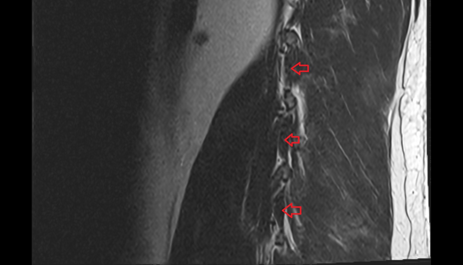 Lateral intertransversarii lumborum muscle MRI  SAGITTAL  anatomy  image-img-00000-00000