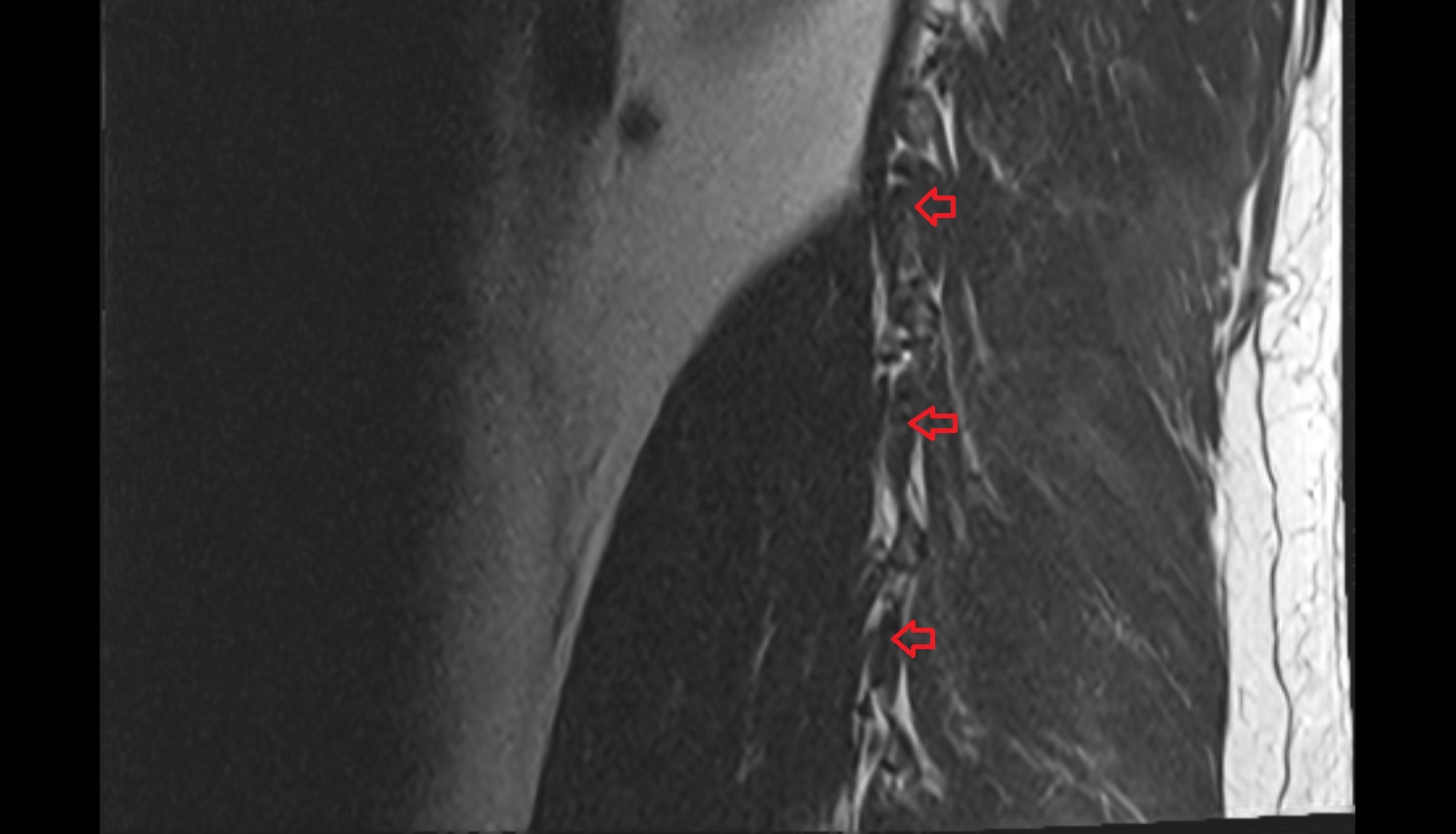 Lateral intertransversarii lumborum muscle MRI  SAGITTAL  anatomy  image-img-00000-00000_00001