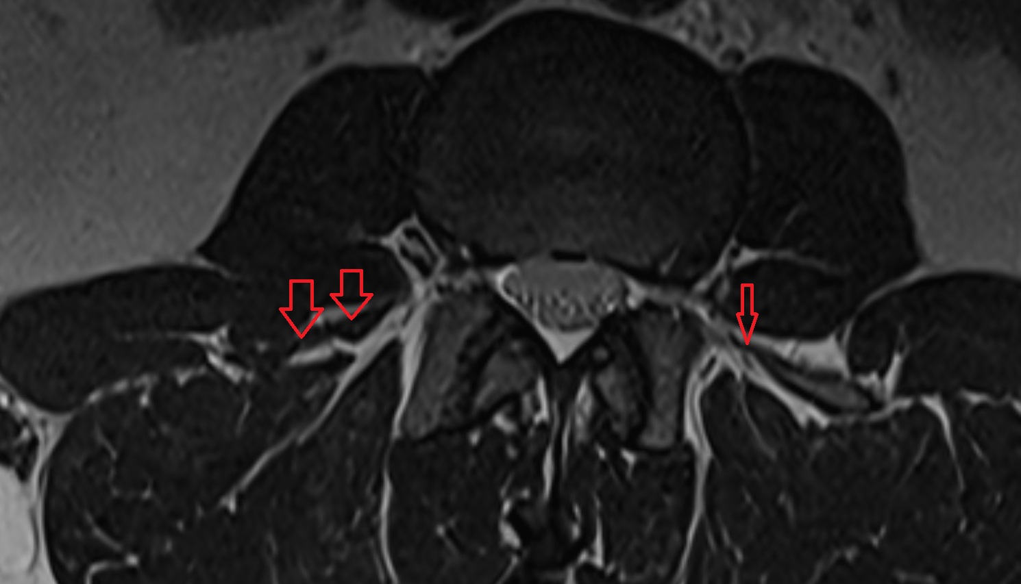 Lateral intertransversarii lumborum muscle MRI  axial  anatomy  image-img-00000-00000