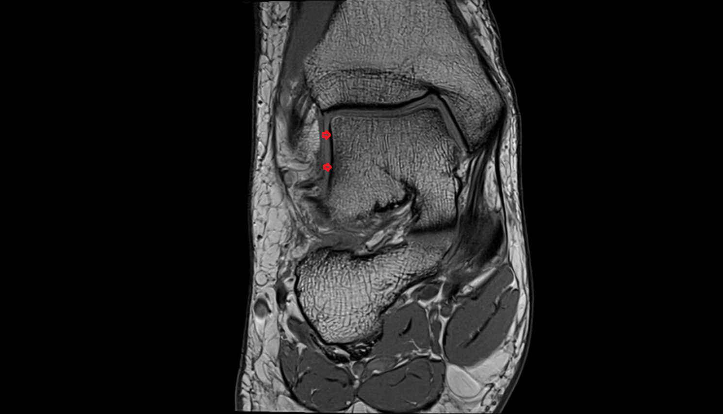 Lateral malleolar facet of talus  mri  anatomy labelled image-img-00000-00000