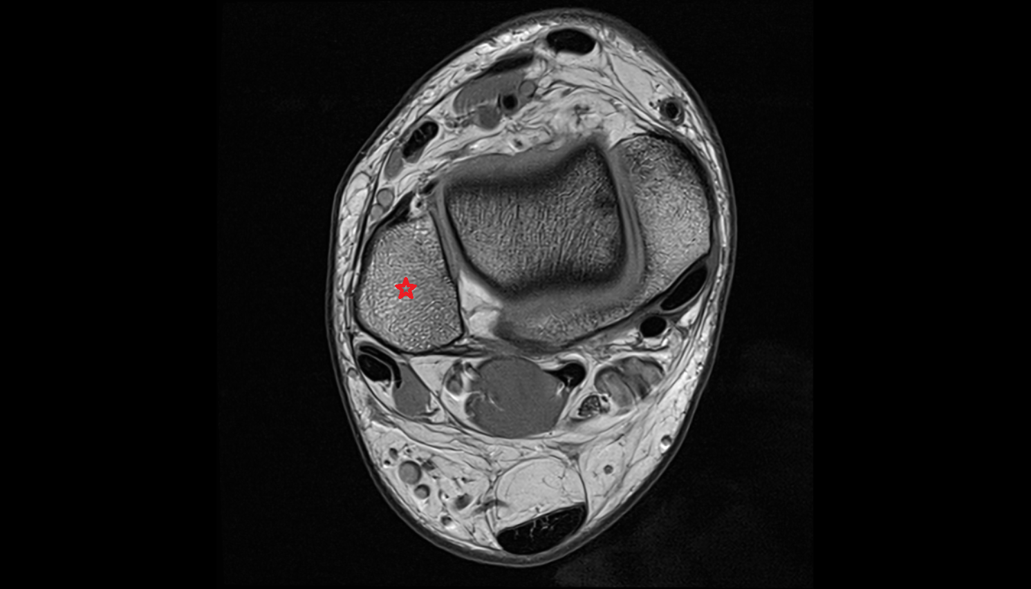 Lateral malleolus  MRI axial  cross sectional anatomy 3T MRI AI enhanced radiology image-img-00000-00000
