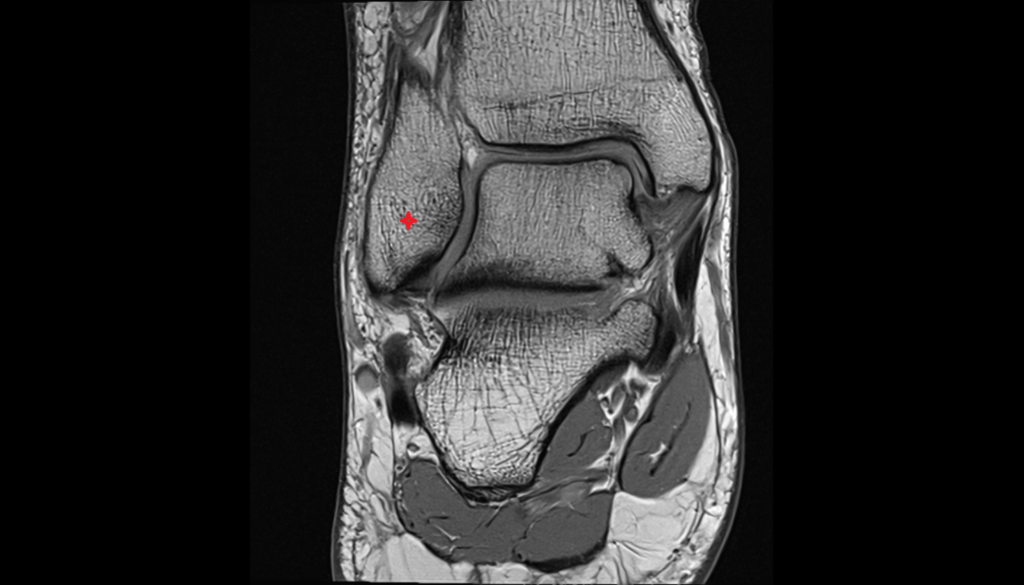 Lateral malleolus  MRI coronal  cross sectional anatomy 3T MRI AI enhanced radiology image-img-00000-00000