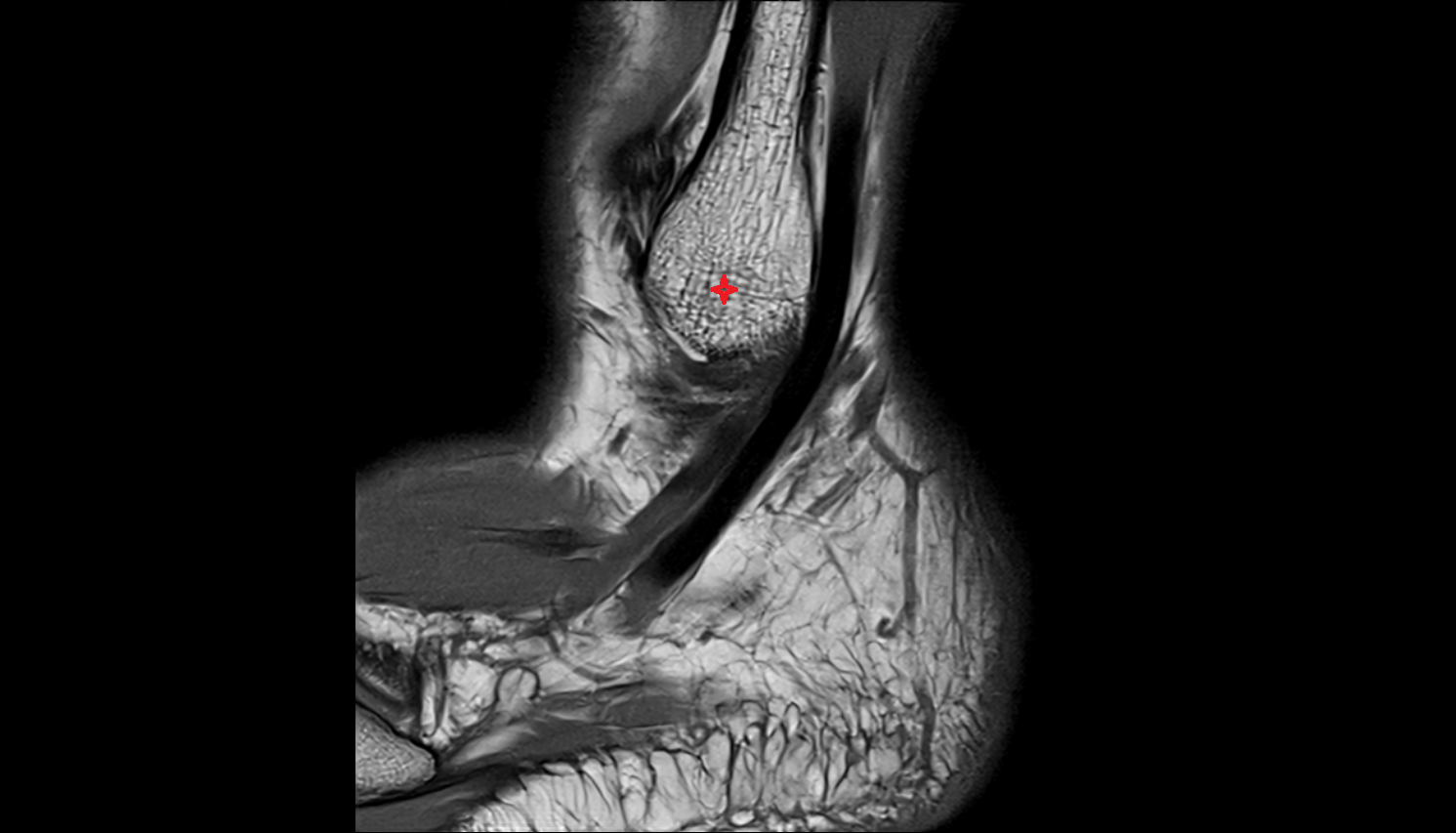 Lateral malleolus  MRI sagittal  cross sectional anatomy 3T MRI AI enhanced radiology image-img-00000-00000