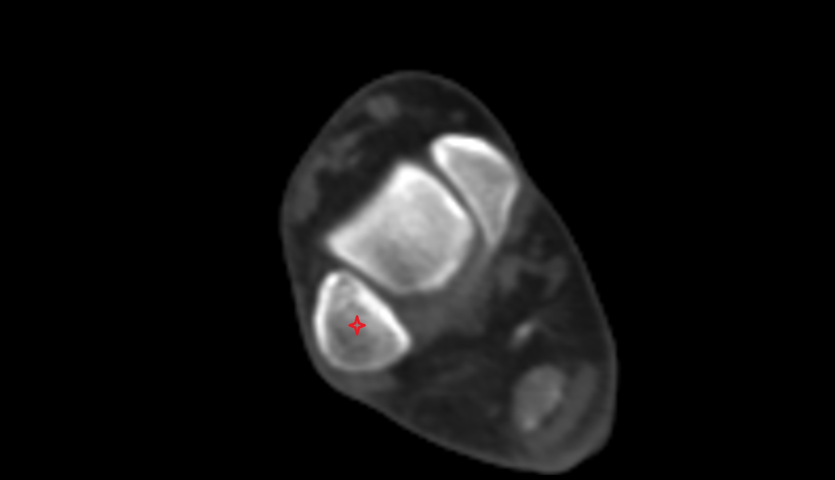 Lateral malleolus ct axial