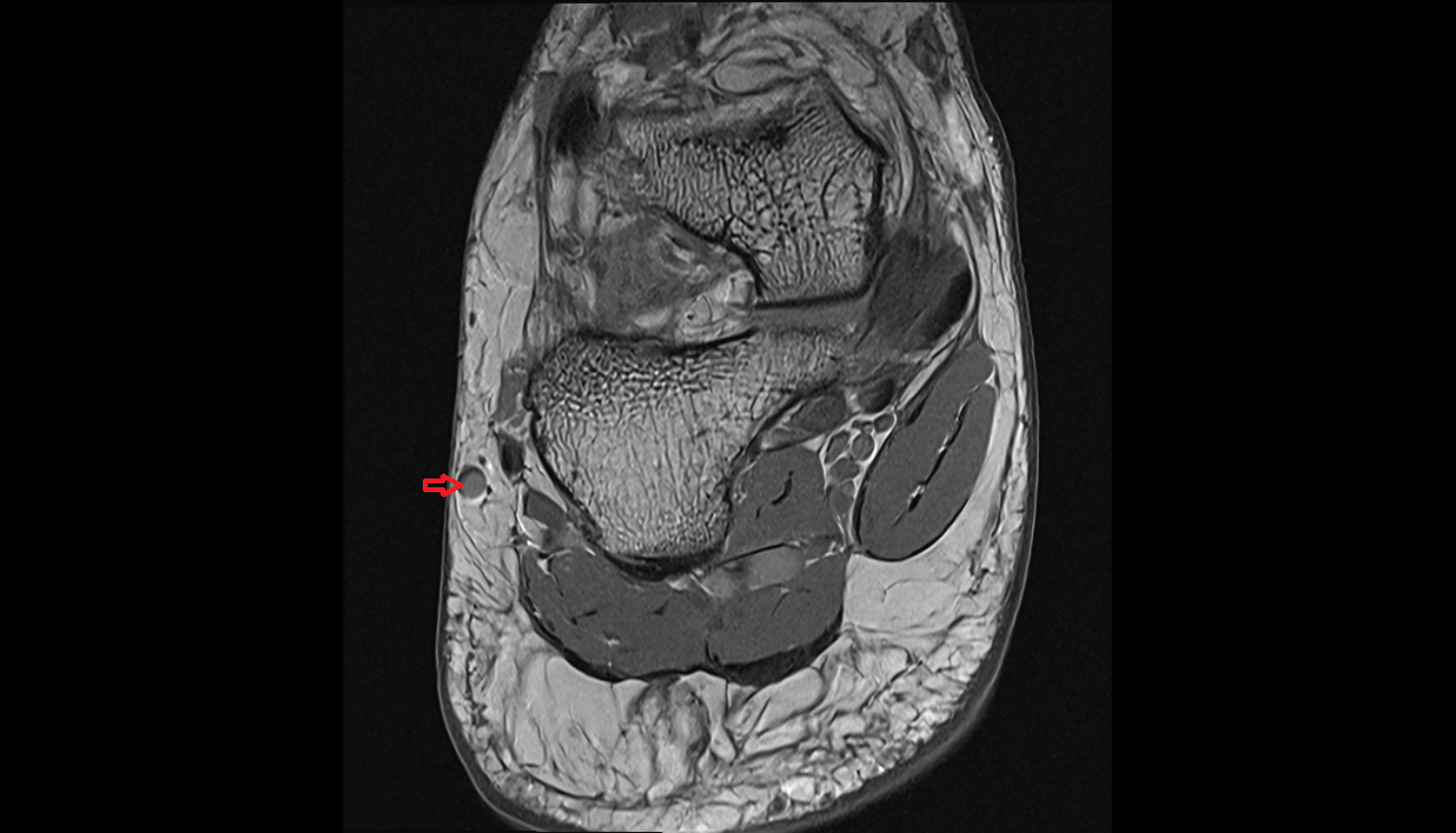 Lateral marginal vein of foot axial cross sectional anatomy 3T MRI AI enhanced radiology image-img-00000-00000