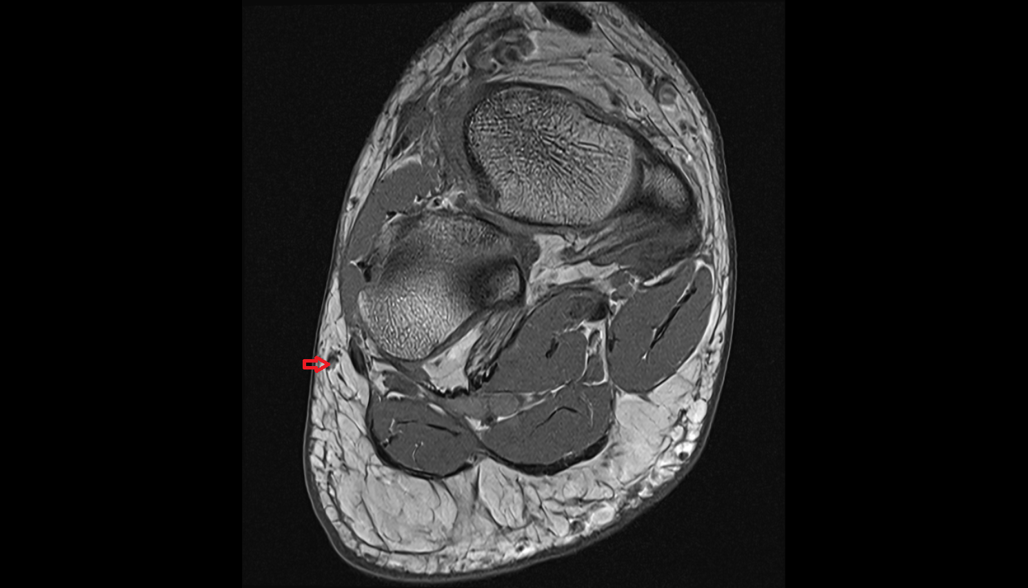Lateral marginal vein of foot axial cross sectional anatomy 3T MRI AI enhanced radiology image-img-00000-00000_00001