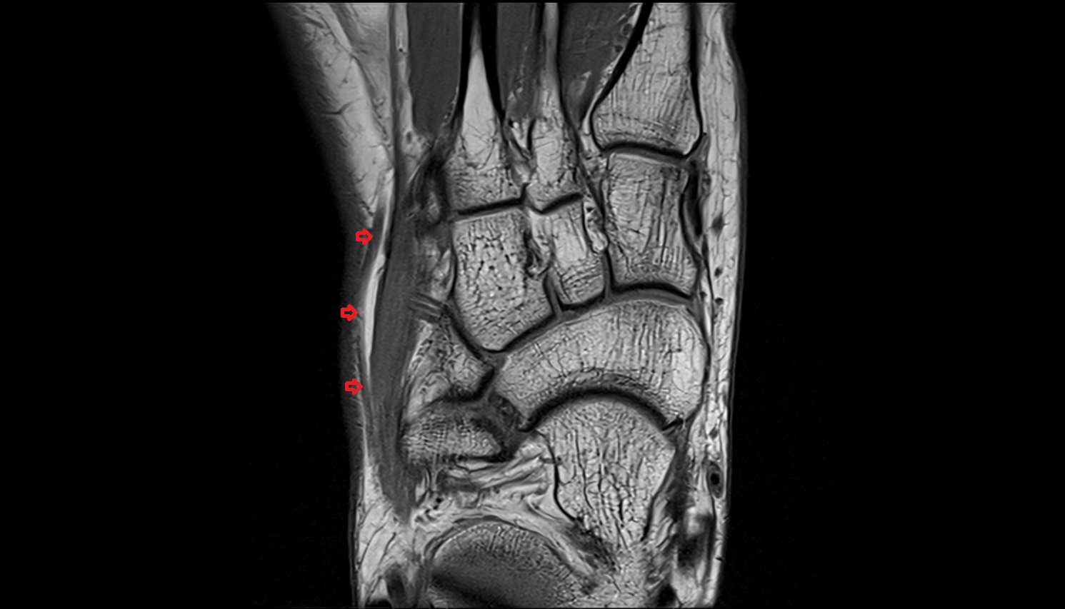 Lateral marginal vein of foot coronal cross sectional anatomy 3T MRI AI enhanced radiology image-img-00000-00000