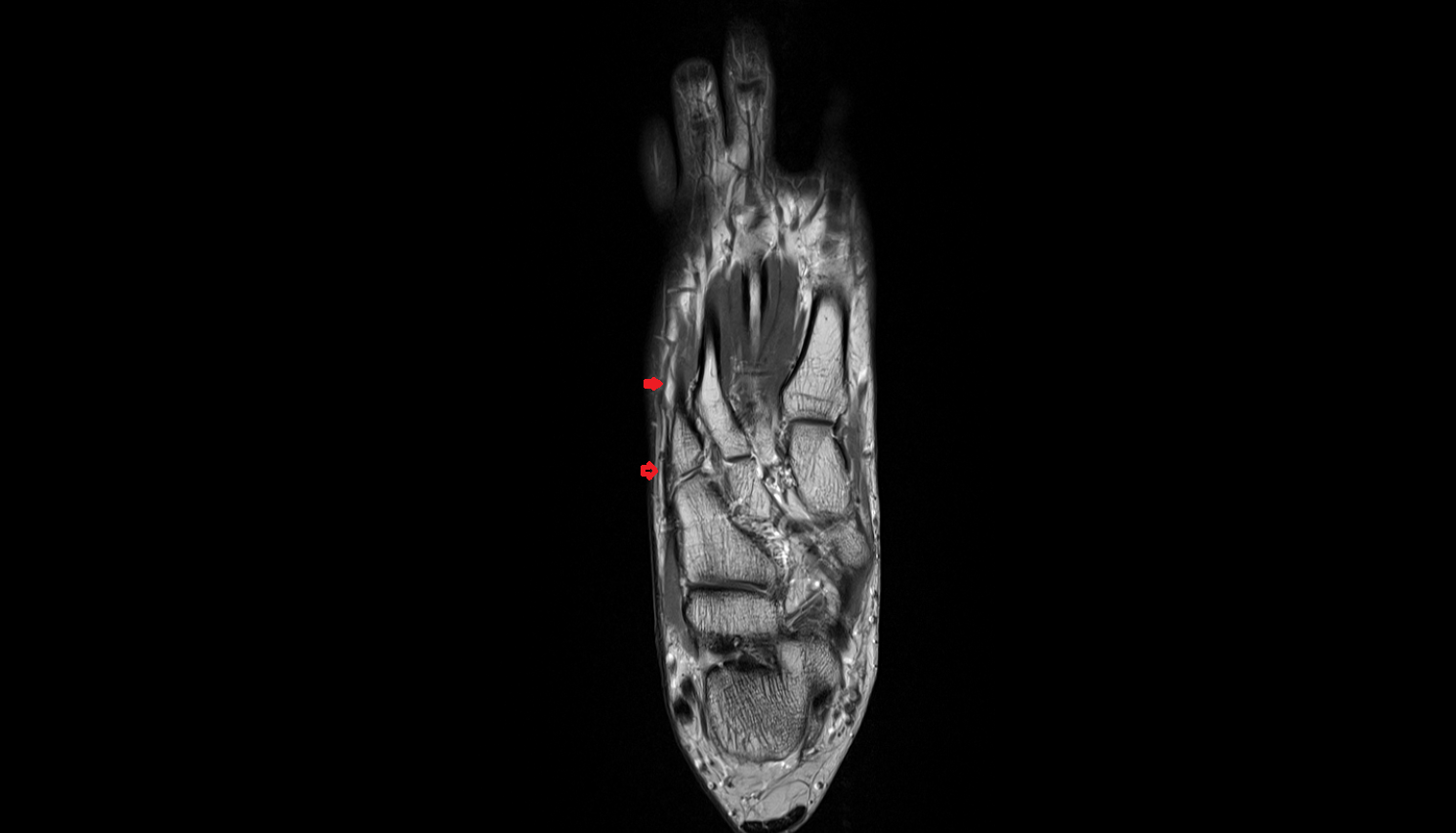 Lateral marginal vein of foot coronal cross sectional anatomy 3T MRI AI enhanced radiology image-img-00000-00000_00001