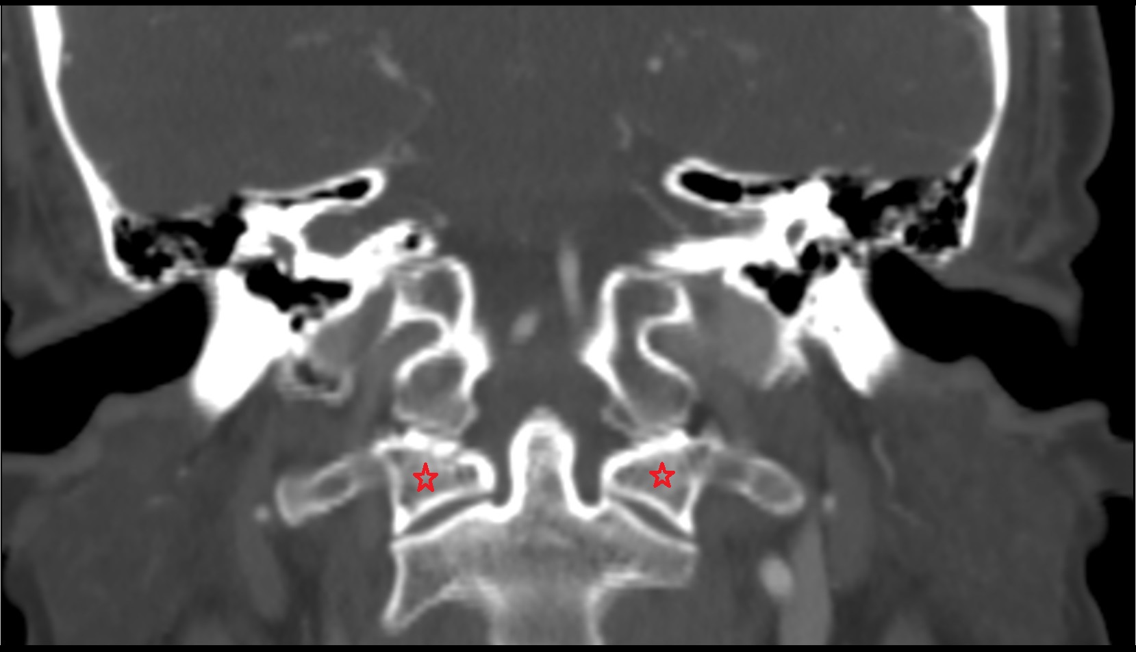 Lateral mass of atlas CT CORONAL